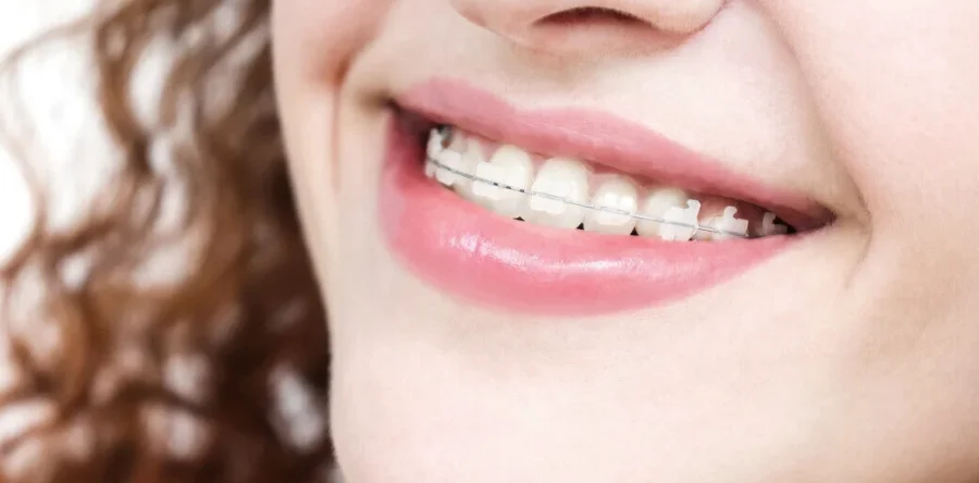 Ceramic (Tooth Coloured) Braces