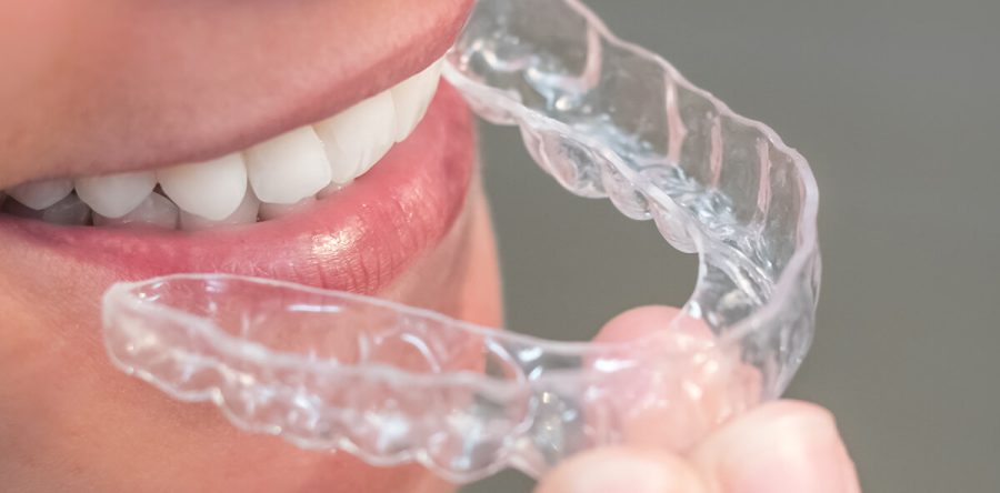 Aligners